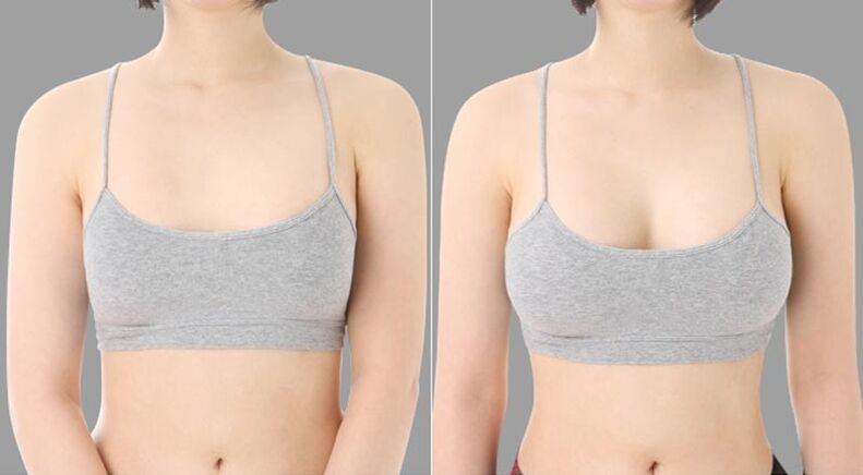 pred in po povečanju prsi
