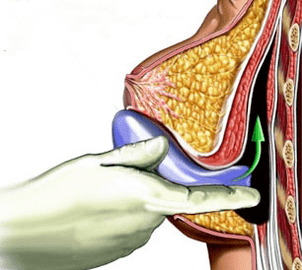 implantacija za povečanje prsi