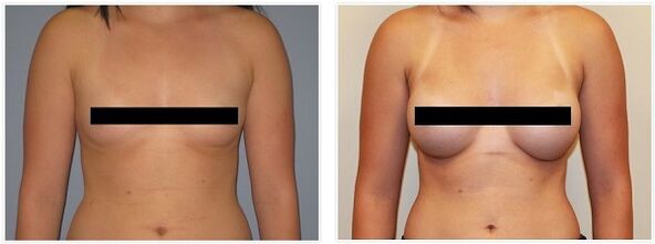 dojke pred in po operaciji