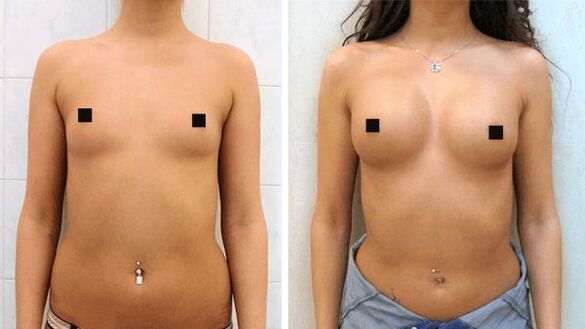 fotografije pred in po kirurškem povečanju dojk