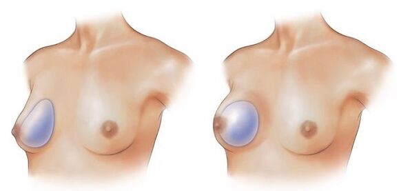 implantati v obliki kapljic za povečanje dojk