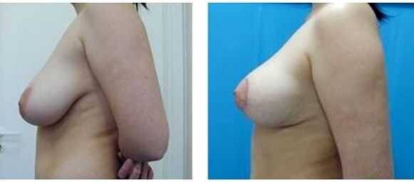 pred in po kirurškem povečanju dojk