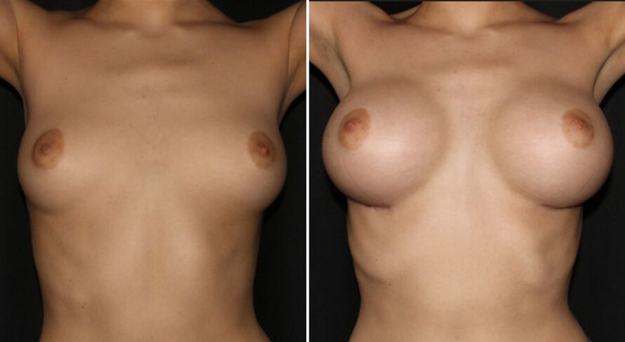 Pred operacijo povečanja dojk in po njej